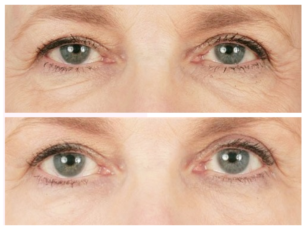 Мезотерапия глаз до и после фото